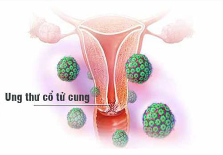 HPV gây ung thư cổ tử cung ở phụ nữ chiếm tỉ lệ rất cao