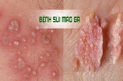 Thời gian ủ bệnh sùi mào gà bao lâu thì biểu hiện triệu chứng? 2 Bệnh sùi mào gà hay còn gọi là bệnh mụn cóc sinh dục