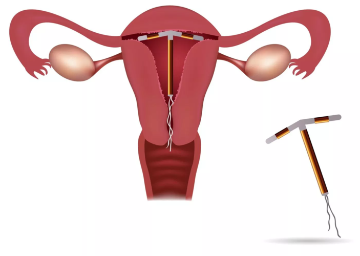 vòng tránh thai hiện đại đặt âm đạo