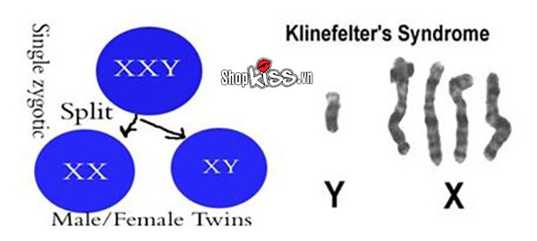 Hội chứng klinefelter là như thế nào