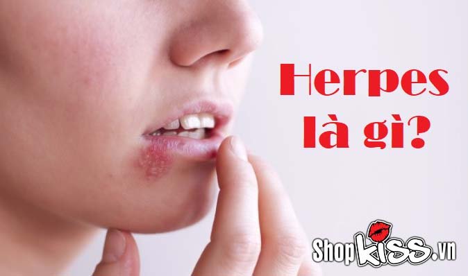 Herpes là gì có nguy hiểm không?