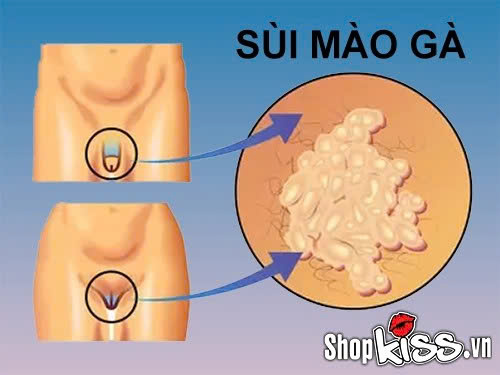 Chuyên gia giải đáp: Ngủ chung có lây sùi mào gà không? 2 Ăn ngủ chung có lây sùi mào gà không?