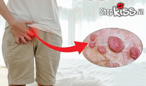 Đeo bao cao su có bị sùi mào gà không? Sự thật ít ai ngờ tới 5 Khi quan hệ đeo bao cao su có bị sùi mào gà không?