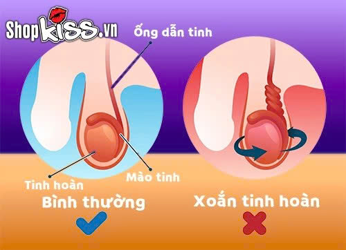 Giải đáp từ chuyên gia: Xoắn tinh hoàn có tự khỏi không? 2 Tình trạng xoắn tinh hoàn có tự khỏi không?