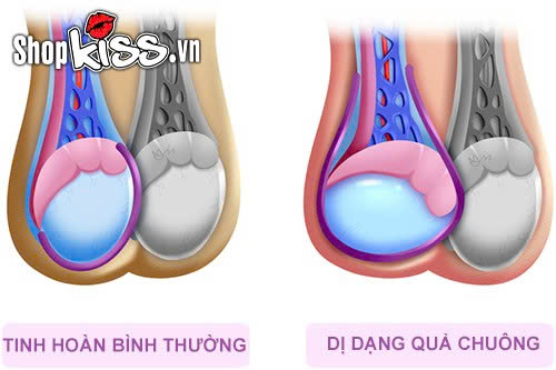 Giải đáp từ chuyên gia: Xoắn tinh hoàn có tự khỏi không? 3 Trẻ em bị xoắn tinh hoàn có tự khỏi không?