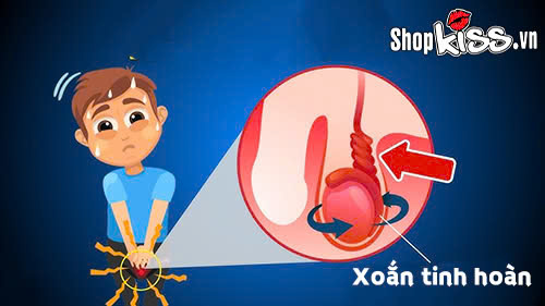 Giải đáp từ chuyên gia: Xoắn tinh hoàn có tự khỏi không? 4 Xoắn tinh hoàn có tự khỏi không?