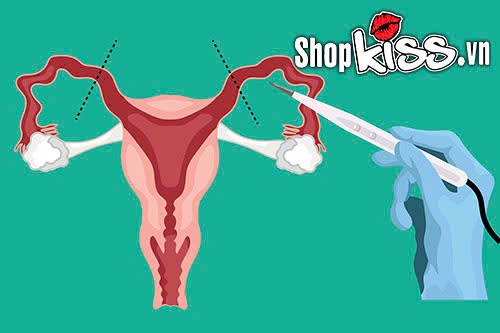 Bác sĩ giải đáp: Thắt ống dẫn tinh có quan hệ được không? 4 Đàn ông thắt ống dẫn tinh có quan hệ được không?