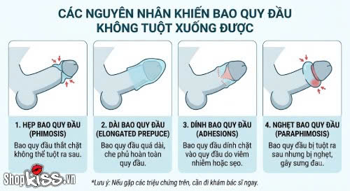 Chưa lột bao quy đầu có quan hệ được không? Bác sĩ giải đáp 4 Bạn trai chưa lột bao quy đầu có quan hệ được không?