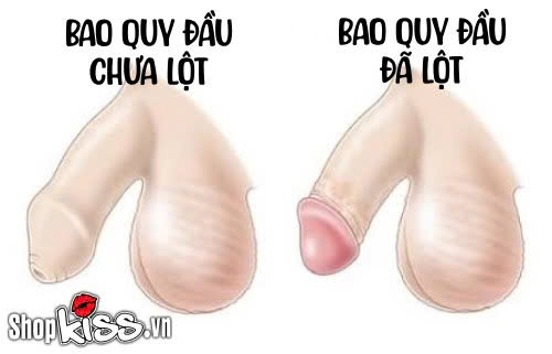 Chưa lột bao quy đầu có quan hệ được không? Bác sĩ giải đáp 3 Con trai chưa lột bao quy đầu có quan hệ được không?