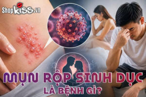 Mụn rộp sinh dục là bệnh gì?