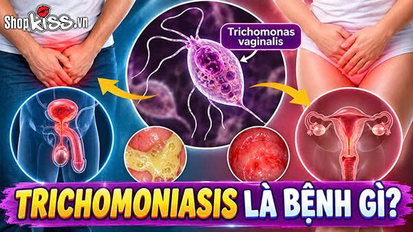Trichomoniasis là bệnh gì? Dấu hiệu và cách điều trị 10 Trichomoniasis là bệnh gì?